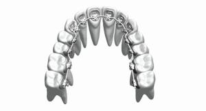 Quality Custom Fixed Orthodontic Appliances Braces Straighten Teeth Stainless Steel Bioceramic wholesale