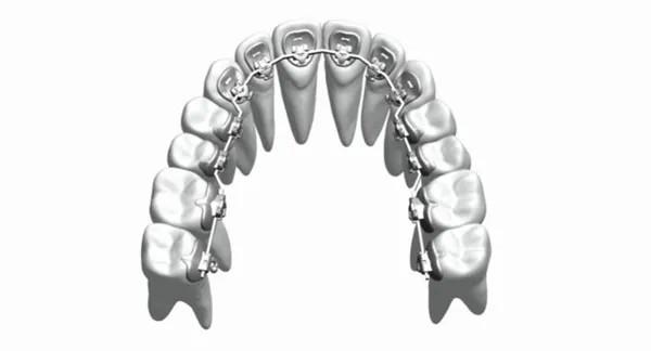 Custom Fixed Orthodontic Appliances Braces Straighten Teeth Stainless Steel
