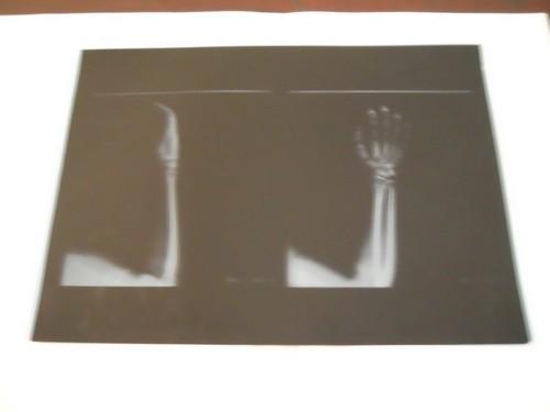 KND-A Low Fog Medical Dry Imaging Film For X Ray Examination On AGFA 5300 11in ×