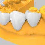 3D Printed Temporary Veneers for Hard Tissue Surfaces Water Absorption Rate 0.5