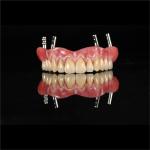 CAM Milled Titanium Bar Dental Implant Hybrid Prosthesis Dentures