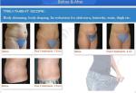 New beauty equipment 13mm focus depth hifu cellulite reduction body weight