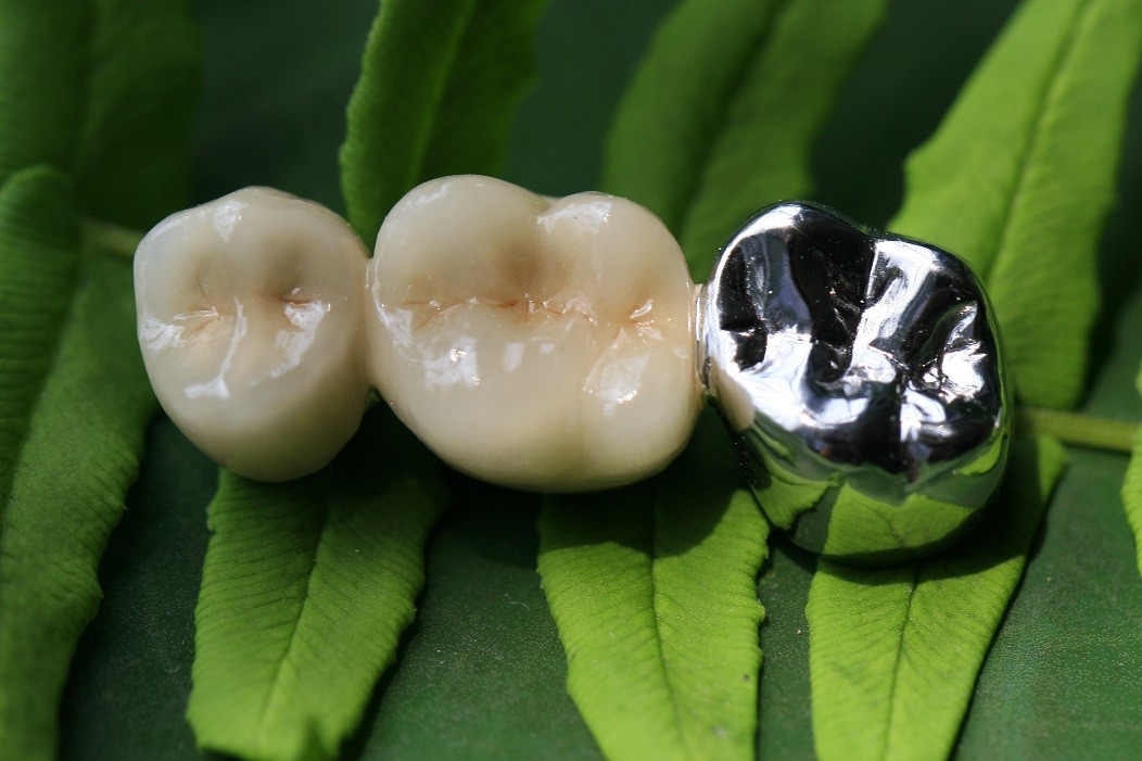 Metal Framework PFM Dental Crown
