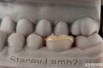 Customizable Zirconia Inlay Onlay Minimal Preparation For Damaged Teeth