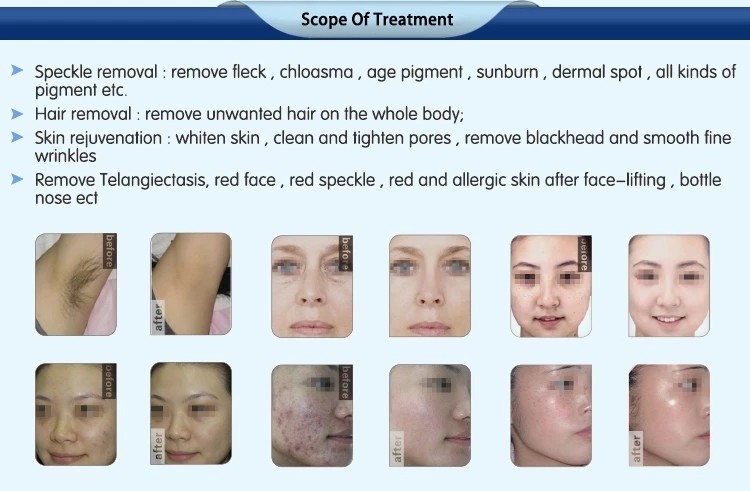 2018 AFT SHR Golden manufacturer super hair removal ipl shr laser machine electric threading hair removal