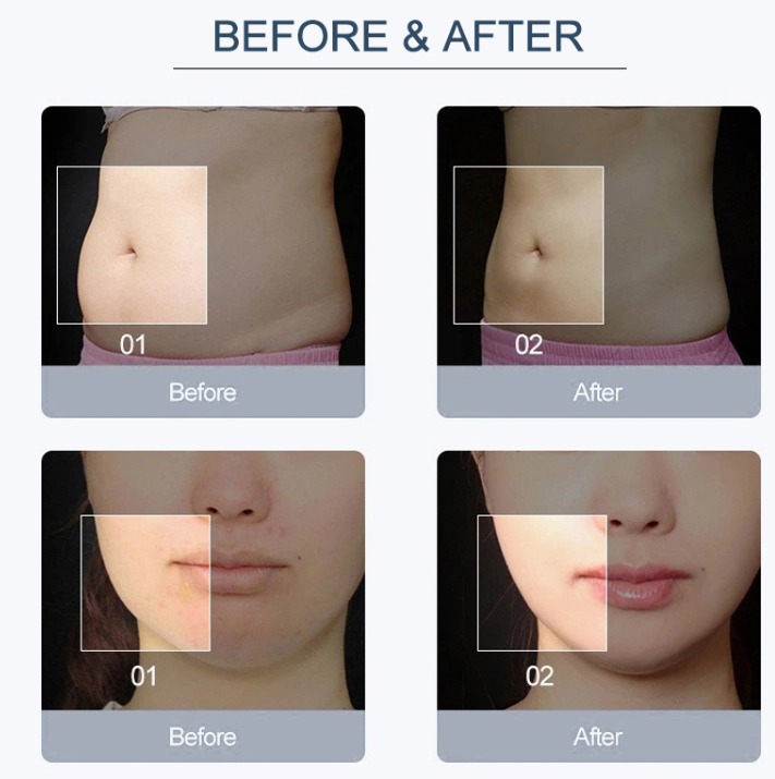 2 In 1 Non Surgical Liposuction Machine 980nm Lipolysis Laser Machine