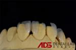 Dentures Aesthetic Emax All Ceramic Crowns Front Teeth OEM