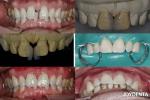 Ceramic For Natural Aesthetics Dental Veneers Stain Resistance Maintains