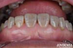 Lightweight Dental Zirconia For Optimal Patient Experience Natural Color