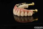 Dental Prosthesis Ti-Bar Zirconia Hybrid Bridge With High Biocompatibility