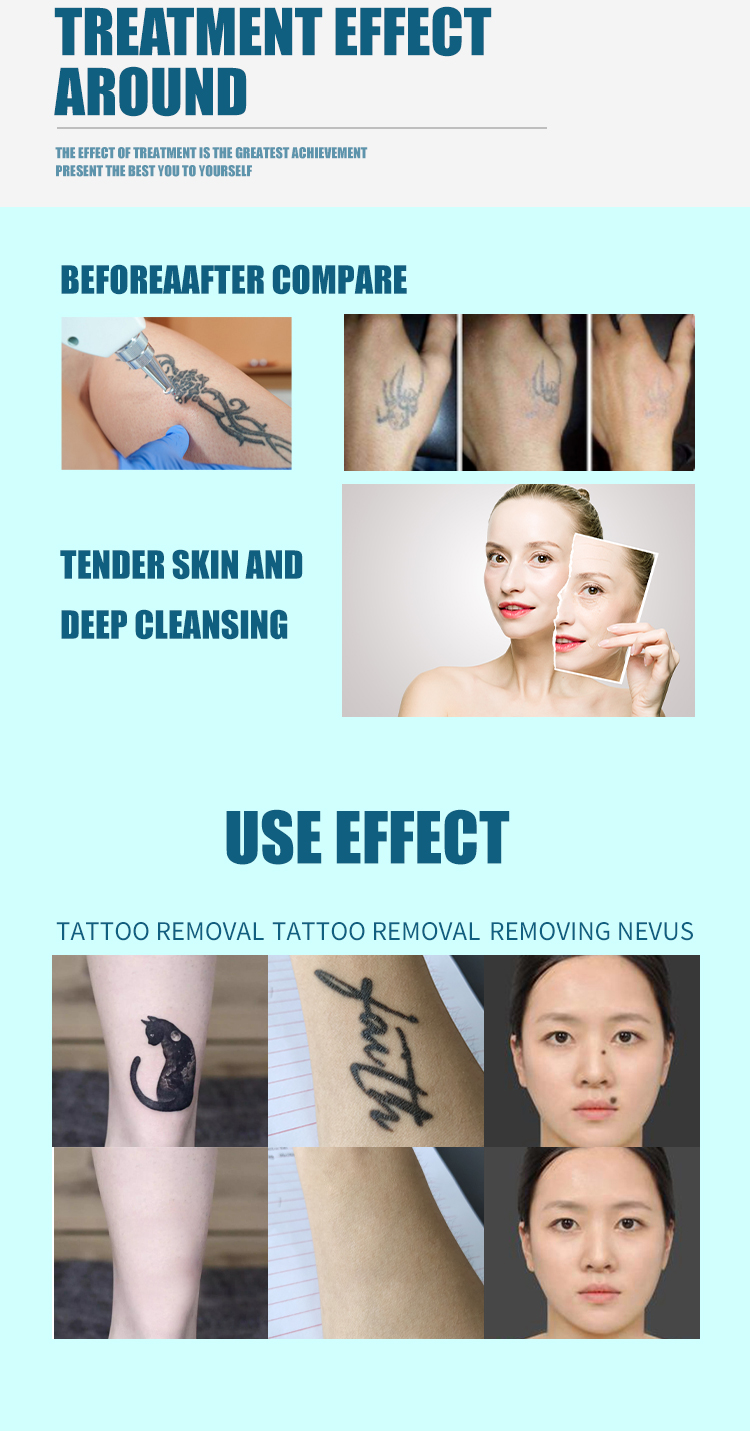 Portable Q Switched Tattoo Removal Machine 1-10Hz Picosecond Yag Laser Machine 1064nm