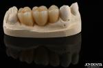 Wear Resistant Zirconia Full Contour Dental Crown High Translucency