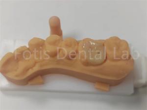 Quality Dental Restorations Ceramic Inlay And Onlay For Long Lasting wholesale