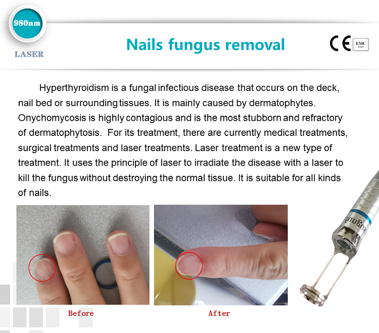 spider veins vascular vein removal nail fungus 980nm diode laser therapy machine for toe nail fungus treatment