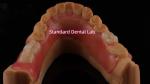 High Esthetics Dental TCS Valplast Flexible Partial Dentures Dental Lab pink