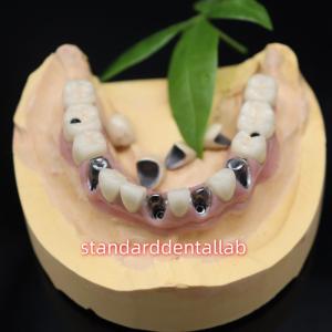 Quality Screw Retained Dental Implant Metal Ceramic Crowns Malo Bridge wholesale