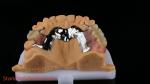 CorCr Metal Partial Denture High Light Beryllium Free Ivoclar Scheftner