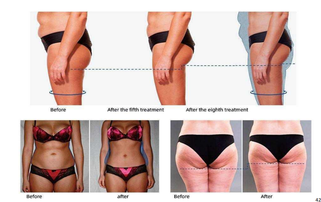 Non Invasive Body Sculpting Machine , Magnetic Muscle Stimulation Machine
