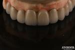 PFM Porcelain Fused to Metal Crowns and Bridges Seamless Bonding for Natural