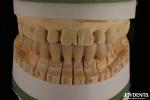 High Aesthetics Porcelain Layered Dental Zirconia For Implant Restorations