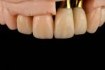 Titanium Sandblasted Single Tooth Replacement Implant With Gamma Irradiation