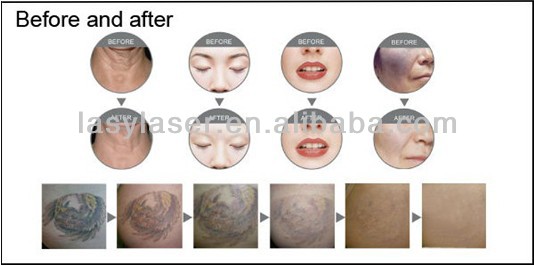 Nanosecond Portable Nd Yag Laser Tattoo Removal Machine 1064nm
