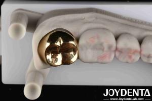 Quality Professional Grade Gold Crown For Dental Oral Clinical Application Yes Abrasive Resistance wholesale