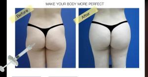Quality Subskin SubQ Injectable Hyaluronic Acid Breast Filler For Buttock Penis Augmentation wholesale