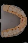 0.3mm Thickness Ips Emax Veneers Ceramic Veneers Anterior Posterior Restorations
