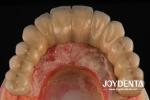 Casting And Milling PFM Tooth Crown , Dental Restorations Porcelain Fused Metal