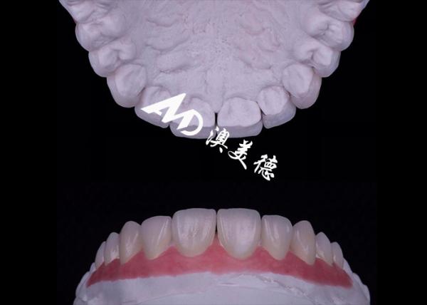 Cheap Translucency EMAX Porcelain Veneer Resistant to Stains / Strength for sale