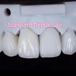 Natural Looking Restorations Aidite Dental Zirconia Tooth Crown