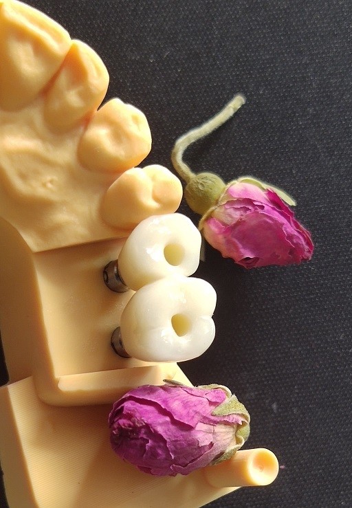 Great Biocompatibility ANKYLOS Dental Implant Supported Crown