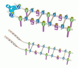 Quality Titanium Orthopedics Posterior Cervical Fixation System wholesale