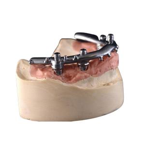 Quality High-Density PFM Dental Implants Dentures Strong Hardness Long Lasting​ wholesale