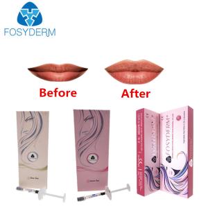 Quality Wrinkles And Lips Hyaluronic Acid Injectable Filler With Lidocaine wholesale