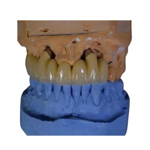 Quality FDA PFM Crown Porcelain fused to Metal Crown wholesale