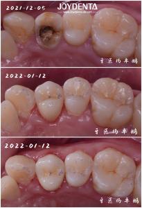 Quality Accurate Fit Dental Porcelain Inlay Damaged Teeth Restoration For Adults And Children wholesale