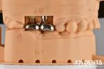 Silver Dental Implant Abutments Customizable Diameter Height CAD CAM Technology