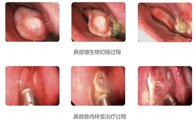 Low Temperature RF Plasma System Cutting Perforation Ablation Cryosurgery Unit