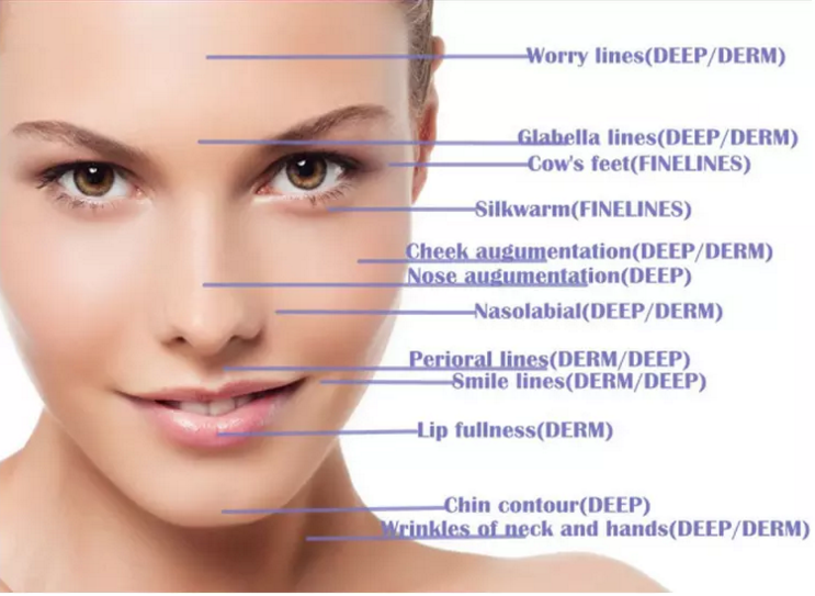 Anti Wrinkle Injectable Dermal Filler Face Contouring With Fine Derm Deep 2Ml Filler