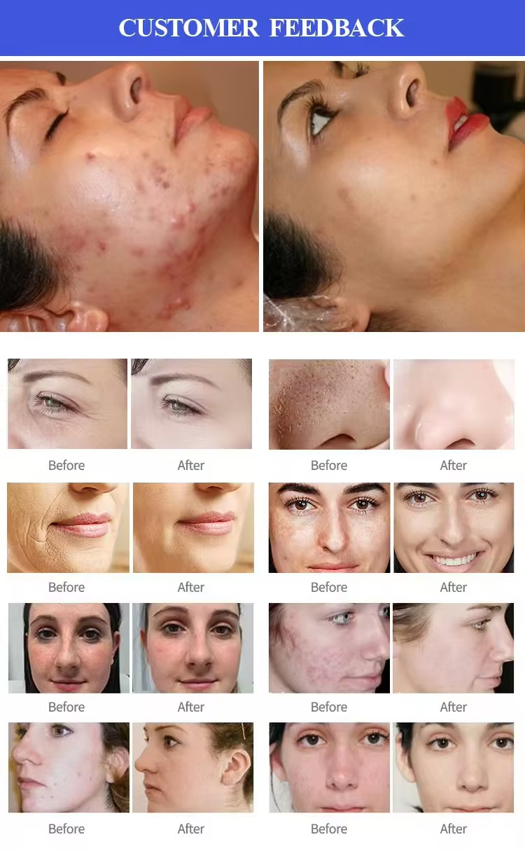 14 In 1 Ultrasonic Scrubber RF Bio Facial Cleaning Hydrodermabrasion Machine