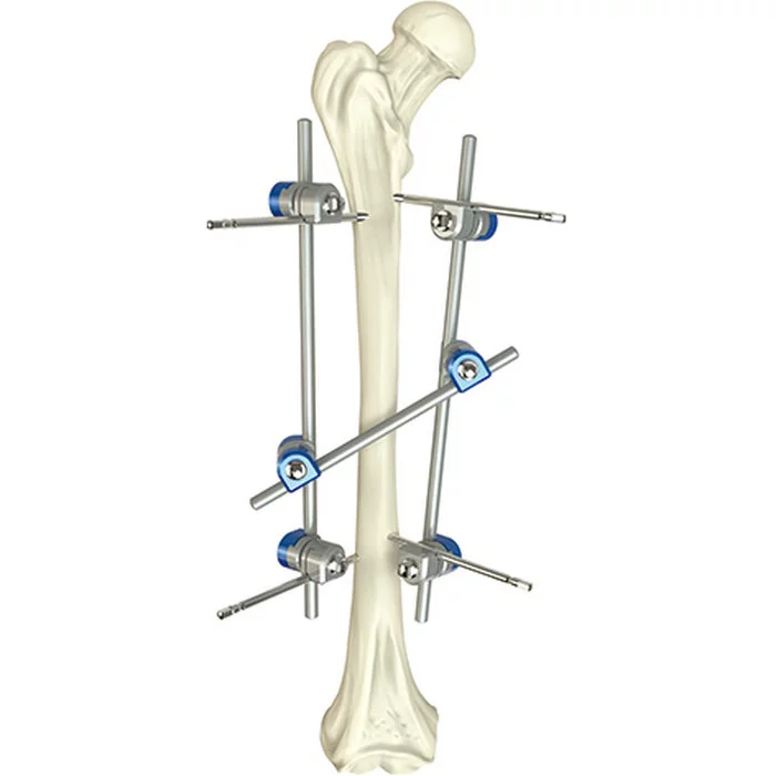Quality Assured Basic Orthopedic Surgical Instrument Femoral Shaft External Fixator Medical Surgical Medical Instruments