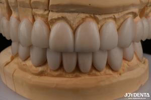 Quality 0.3mm Thickness Ips Emax Veneers Ceramic Veneers Anterior Posterior Restorations wholesale