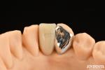 Ideal Matching Clinical Bonding Maryland Dental For Oral Clinical Repair Work