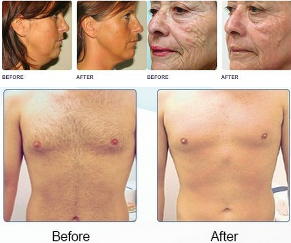 Christmas Discount!! Professional Good Quality hair removal ipl shr medical ipl laser
