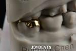 Oral Rehabilitation With Dental Achieve Brighter And Healthier Smile