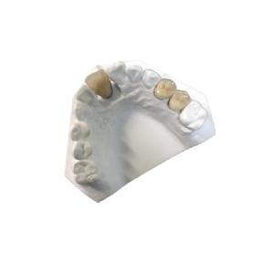 Quality Yellow Gold Porcelain Dental Crown OEM High Strength New Condition wholesale