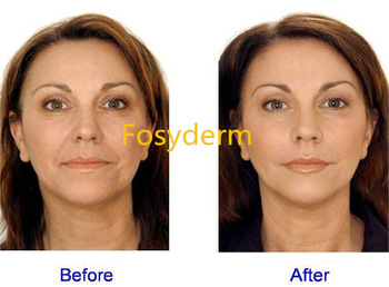 Anti Wrinkle Dermal Filler Hyaluronic Acid Facial Filler Injection 2ml Deep