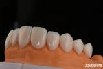A1-A4 Ips Emax Press Porcelain Dental Veneers Stain Resistant Customizable Shape